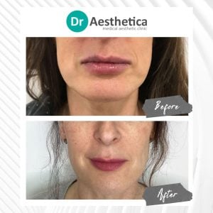 Jawline slimming with Botox before and after results at Dr. Aesthetica Clinic in Birmingham.
