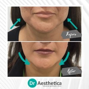 Natural jawline enhancement using Botox injections at Dr. Aesthetica Birmingham—before and after comparison.