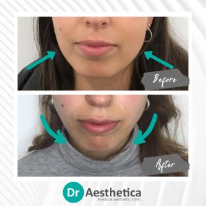 Masseter reduction with Botox before and after results at Dr. Aesthetica Birmingham highlighting V-shaped contour.