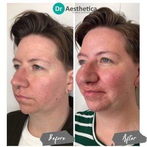 Before and after jawline filler injections at Birmingham’s Dr. Aesthetica Clinic for a more defined, youthful look.