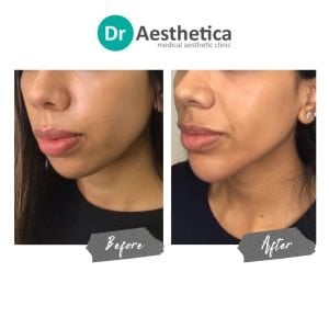Non-surgical facial sculpting with jawline filler at Dr. Aesthetica Birmingham, before and after comparison.