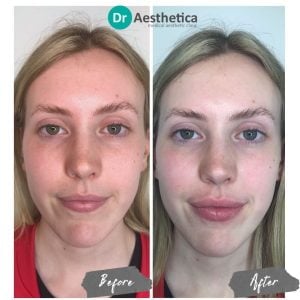 Dermal filler lip enhancement results at Dr. Aesthetica Birmingham—achieving volume and natural definition.