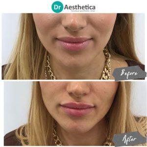 Lip filler before and after comparison showing balanced proportions and smooth contour at Dr. Aesthetica.