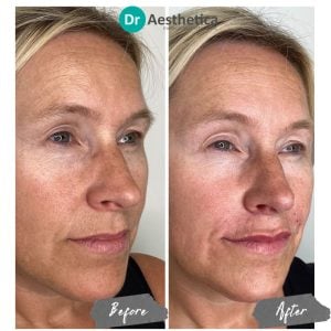 Lip filler before and after results at Dr. Aesthetica Clinic Birmingham—natural, fuller lips with improved shape.