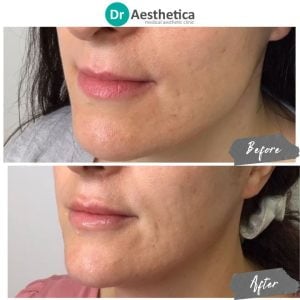 Before and after lip filler injections for fuller, youthful lips by Dr. Aesthetica Birmingham.