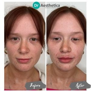 Before and after lip filler treatment at Dr. Aesthetica Birmingham showing enhanced lip volume and symmetry.