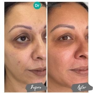 Advanced stem cell microneedling therapy results at Dr. Aesthetica Birmingham highlighting improved firmness and glow.