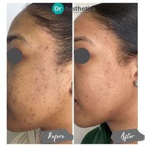 Skin regeneration with stem cell microneedling—before and after images from Dr. Aesthetica Birmingham.