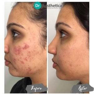 Regenerative stem cell microneedling at Dr. Aesthetica Birmingham—visible reduction in fine lines and scarring.