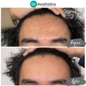 Before and after photos of stem cell-enhanced microneedling stimulating collagen at Dr. Aesthetica Birmingham.