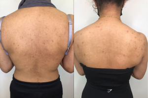 Stem cell microneedling results at Dr. Aesthetica Clinic Birmingham—improved tone, texture, and radiance.