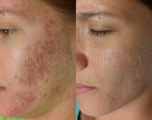 Before and after stem cell microneedling treatment at Dr. Aesthetica Birmingham showing smoother, rejuvenated skin.