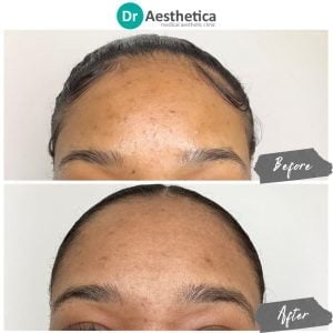 Before and after regenerative microneedling using stem cell serum at Birmingham’s Dr. Aesthetica aesthetic clinic.