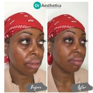 A patient in Dr Aesthetica's clinic in birmingham displaying Dark Under Eye treatment results