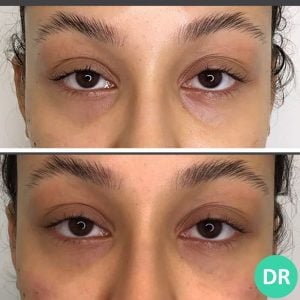 A lady having undergone NCTF treatment in birmingham