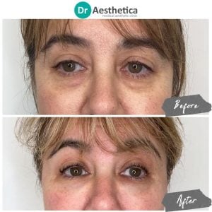 Before and After Results of NCTF treatment in birmingham