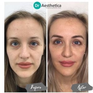 A woman in our birmingham clinic who had nasolabial filler
