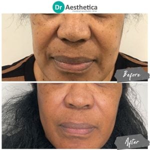 Before and After shot of a woman who received nasolabial filler in birmingham