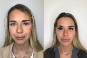 a patient at the dr aesthetica birmingham clinic with their temple filler results