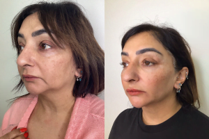 A before and after image of a lady who received temple filler at Dr Aesthetica's birmingham clinic