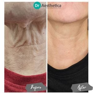Non-surgical neck rejuvenation using Sunekos, before and after images from Dr. Aesthetica Birmingham.