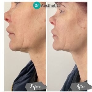 Before and after photos of Sunekos neck injections restoring hydration and collagen at Dr. Aesthetica Birmingham.