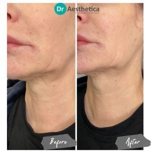 Before and after Sunekos neck treatment at Dr. Aesthetica Birmingham showing improved skin texture and elasticity.