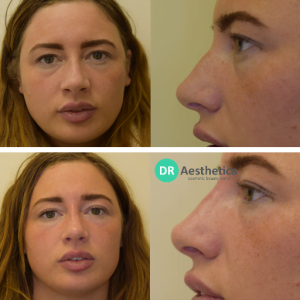 Results of rhinoplasty for a patient at our west midlands clinic