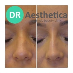 female patient Before and after rhinoplasty at our clinic