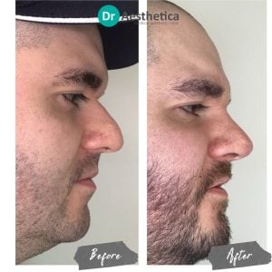 Before and after - rhinoplasty at dr aesthetica