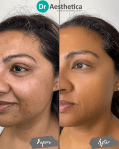Collagen-stimulating RF microneedling results from Dr. Aesthetica Birmingham—improved tone and elasticity.