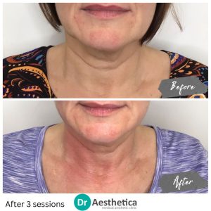 Before and after radiofrequency microneedling at Dr. Aesthetica Birmingham showing firmer, smoother skin texture.