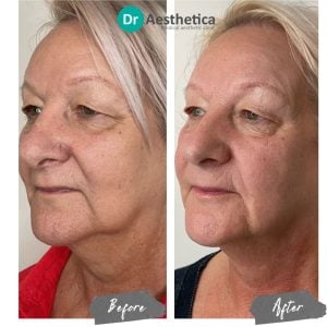 Skin tightening treatment results at Birmingham’s Dr. Aesthetica showing rejuvenated, toned appearance.