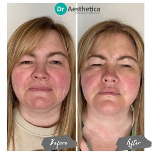 Before and after non-surgical facial tightening with RF technology performed at Dr. Aesthetica Birmingham.