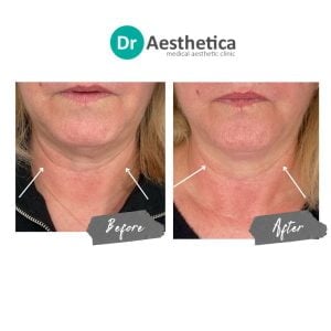 Skin tightening before and after images demonstrating reduced sagging and improved jawline definition at Dr. Aesthetica Birmingham.