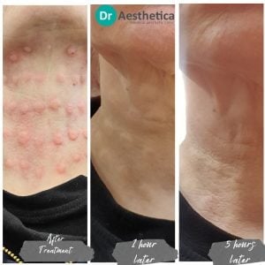 Sunekos injectable skin booster results at Dr. Aesthetica Clinic Birmingham—improved elasticity and glow.