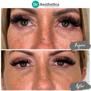 Before and after Sunekos treatment at Dr. Aesthetica Birmingham showing brighter, smoother, and more hydrated skin.