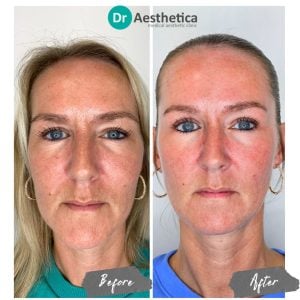 Collagen-boosting Sunekos treatment before and after images demonstrating refreshed, radiant skin at Dr. Aesthetica Birmingham.