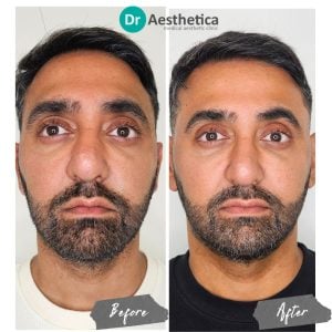 Before and after Sunekos injections at Birmingham’s Dr. Aesthetica aesthetic clinic showing reduced fine lines.