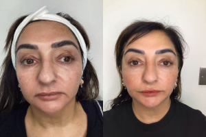 Before and after results of a patient receiving temple filler at dr aesthetica, birmingham