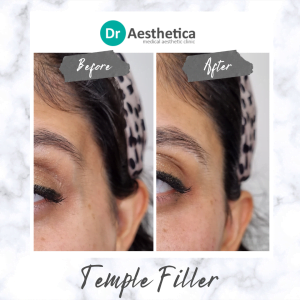 Before and After images of a patient at our birmingham clinic for temple filler