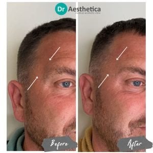 a man who received temple filler in our birmingham clinic