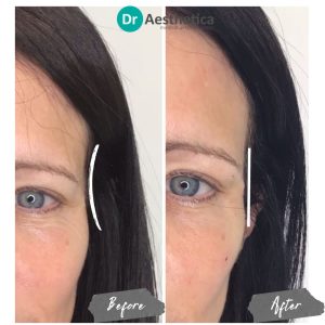 Before and after temple filler at dr aesthetica birmingham