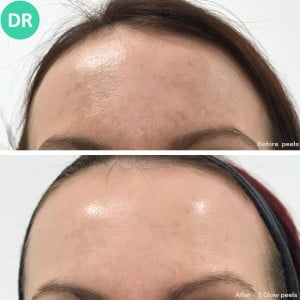Chemical skin peel results at Dr. Aesthetica Clinic Birmingham—improved skin tone and reduced blemishes.