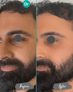 Before and After of Male Aesthetics Treatment at Dr Aestetica's Birmingham Clinic