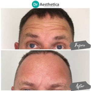 A before and after image of a male who has been treated at Dr Aesthetica's Birmingham Clinic