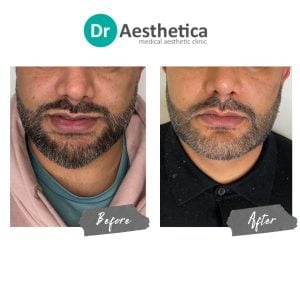 A before and after image of a male who has been treated at Dr Aesthetica's Birmingham Clinic