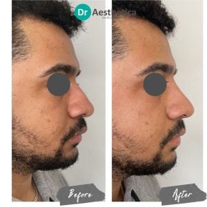 A before and after image of a male who has been treated at Dr Aesthetica's Birmingham Clinic
