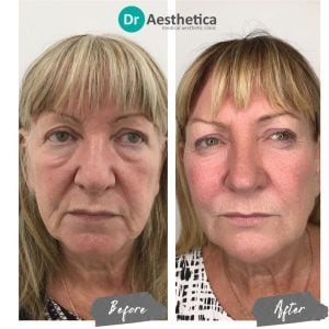 A before and after image from a patient who received a non surgical facelift at Dr Aesthetica Birmingham