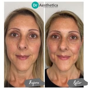 Side by side of a blond haired woman before and after receiving a full non surgical facelift at our birmingham clinic